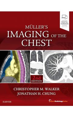 Muller's Imaging of the Chest: Expert Radiology Series